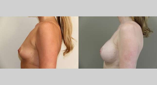 Breast Augmentation: Image #705