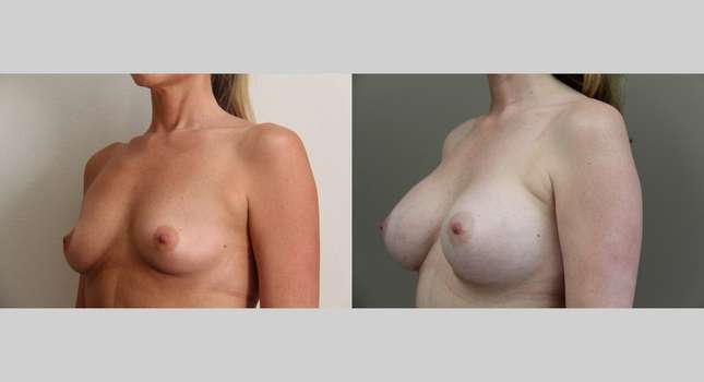 Breast Augmentation: Image #706