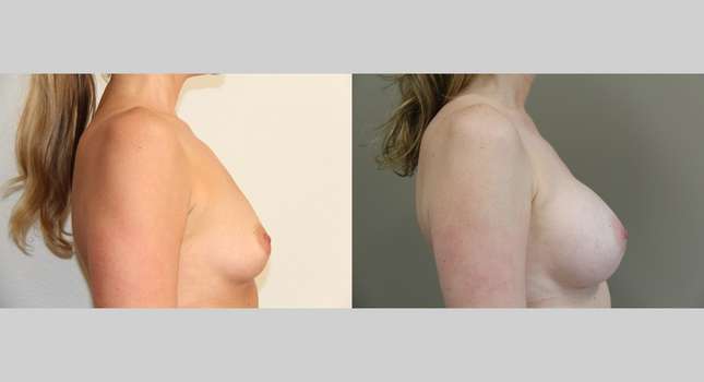 Breast Augmentation: Image #707