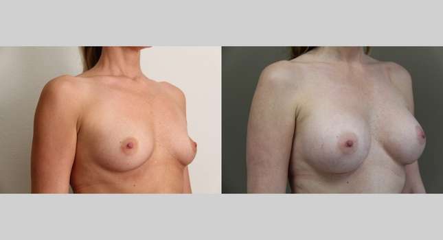 Breast Augmentation: Image #708