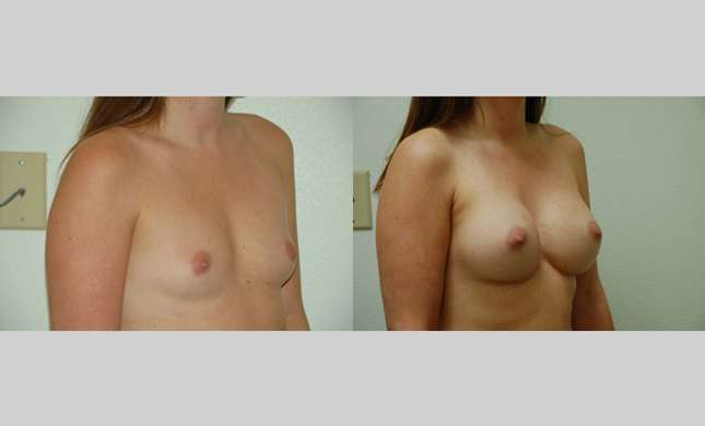 Breast Augmentation: Image #71