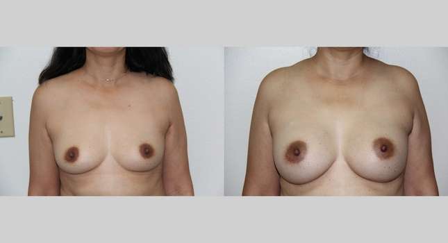 Breast Augmentation: Image #725
