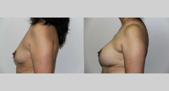 Breast Augmentation: Image #726