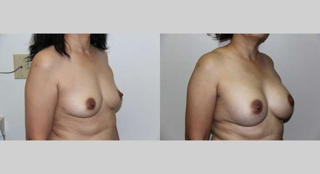 Breast Augmentation: Image #727