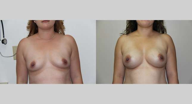 Breast Augmentation: Image #730