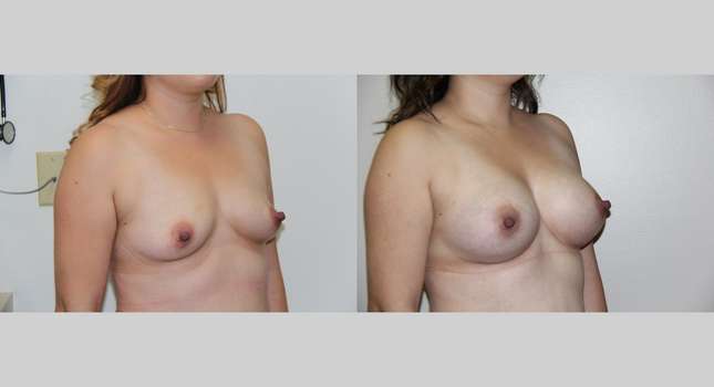 Breast Augmentation: Image #731