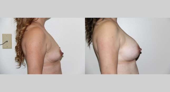 Breast Augmentation: Image #732