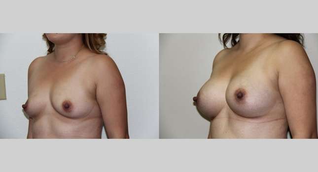 Breast Augmentation: Image #733