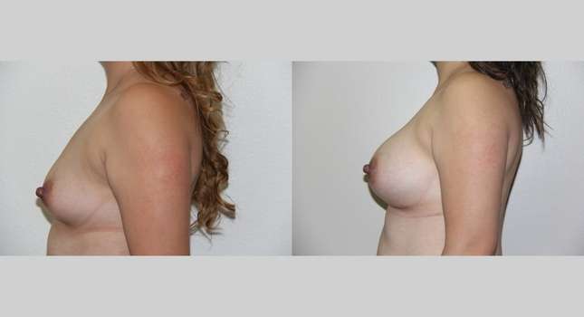 Breast Augmentation: Image #735