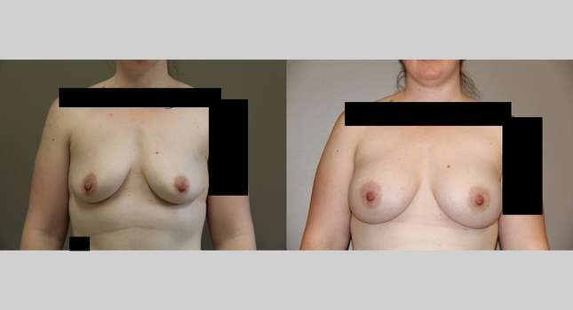 Breast Augmentation: Image #736
