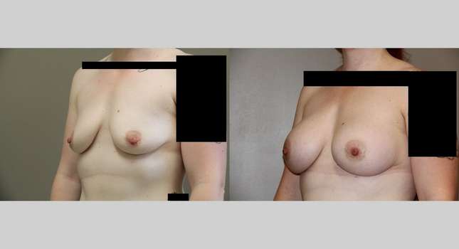 Breast Augmentation: Image #737