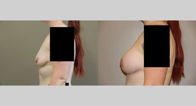 Breast Augmentation: Image #738