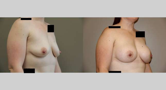 Breast Augmentation: Image #739