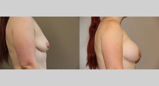 Breast Augmentation: Image #740