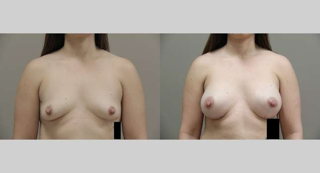 Breast Augmentation: Image #754