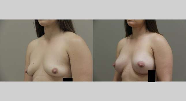 Breast Augmentation: Image #755