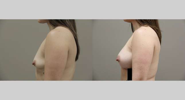 Breast Augmentation: Image #756