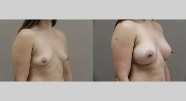 Breast Augmentation: Image #757