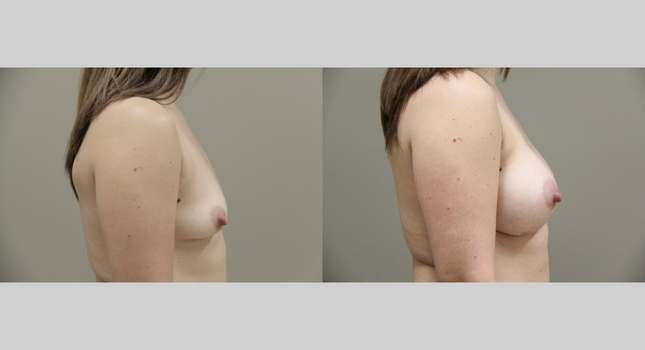 Breast Augmentation: Image #758