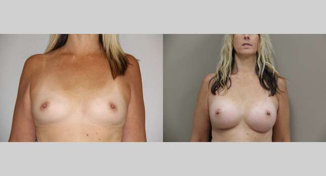 Breast Augmentation: Image #760