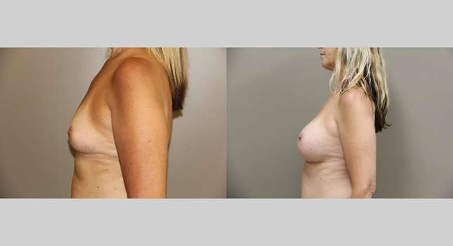 Breast Augmentation: Image #761