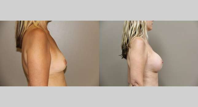 Breast Augmentation: Image #762