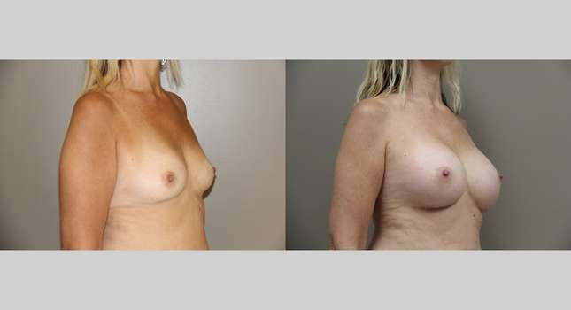 Breast Augmentation: Image #763