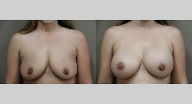 Breast Augmentation: Image #772