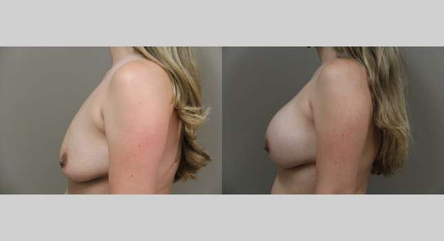 Breast Augmentation: Image #773