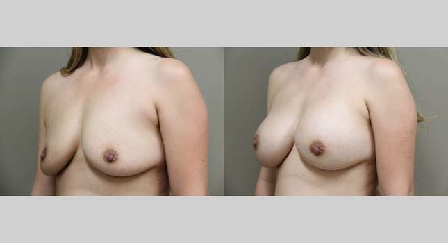 Breast Augmentation: Image #774