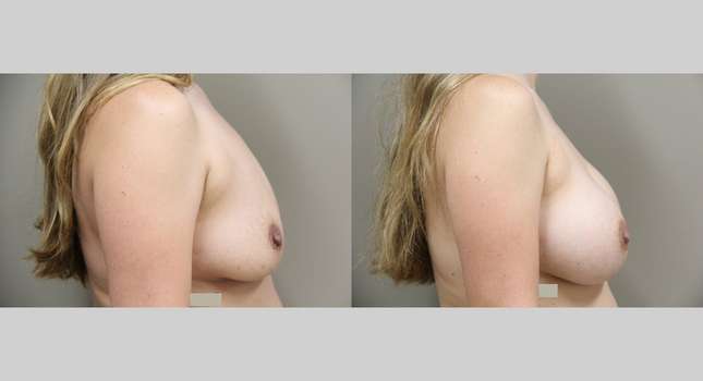 Breast Augmentation: Image #775