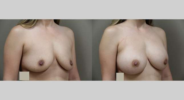 Breast Augmentation: Image #776