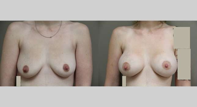 Breast Augmentation: Image #778