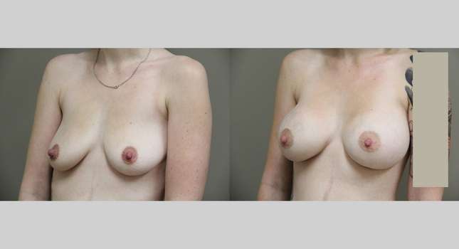 Breast Augmentation: Image #780
