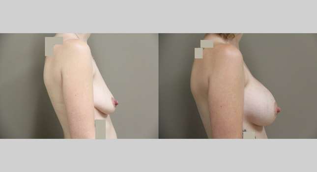 Breast Augmentation: Image #781