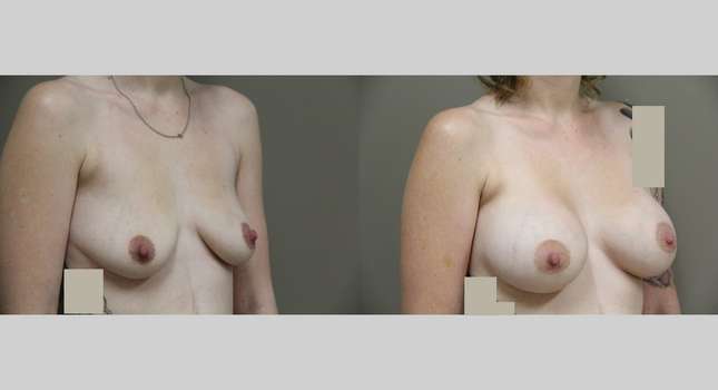Breast Augmentation: Image #782