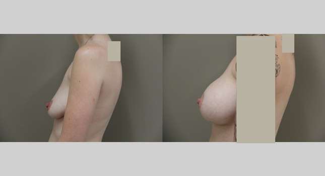 Breast Augmentation: Image #783