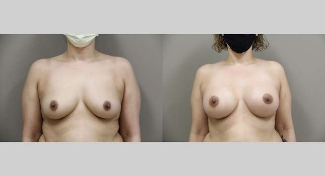Breast Augmentation: Image #784