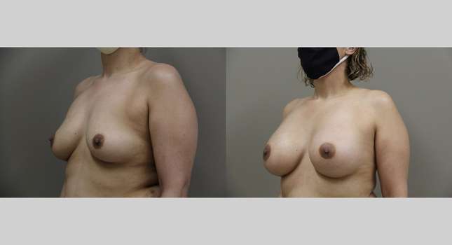 Breast Augmentation: Image #785