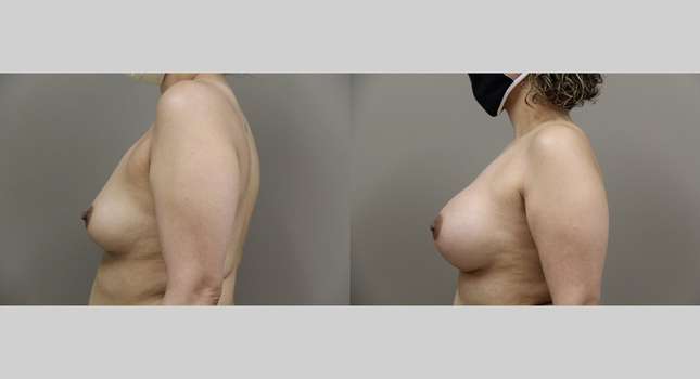 Breast Augmentation: Image #786