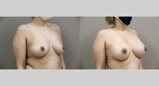 Breast Augmentation: Image #787