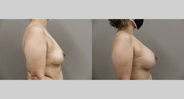 Breast Augmentation: Image #788