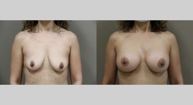Breast Augmentation: Image #789