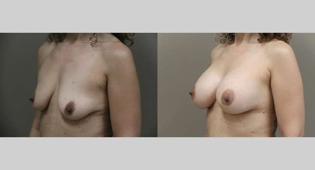 Breast Augmentation: Image #790