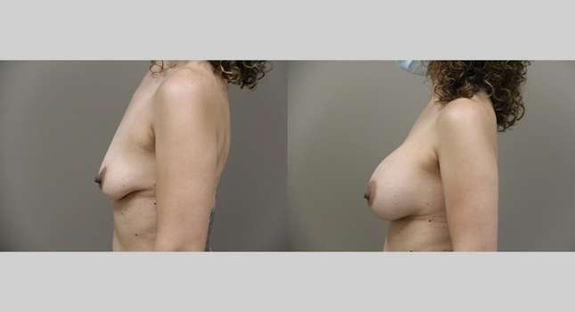 Breast Augmentation: Image #791