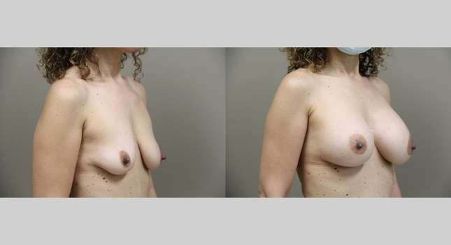 Breast Augmentation: Image #792