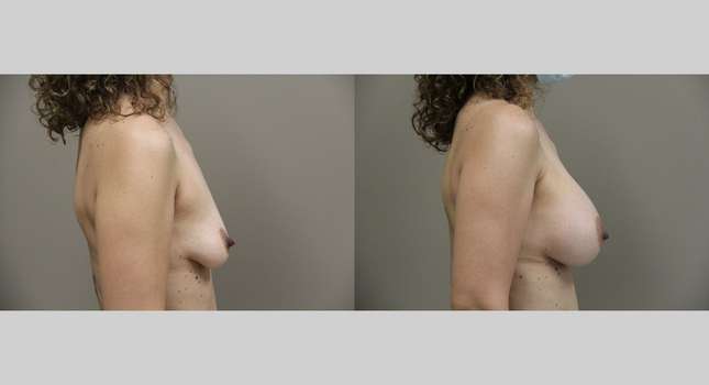 Breast Augmentation: Image #793