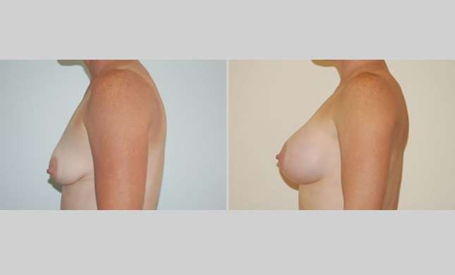 Breast Augmentation: Image #8