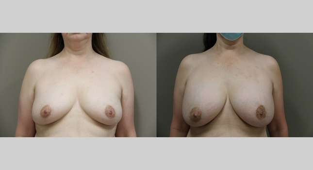 Breast Augmentation: Image #821