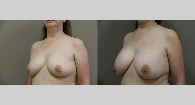 Breast Augmentation: Image #822
